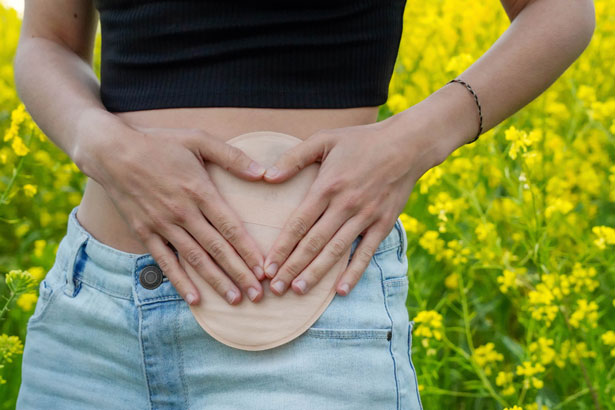 Woman with ostomy bag